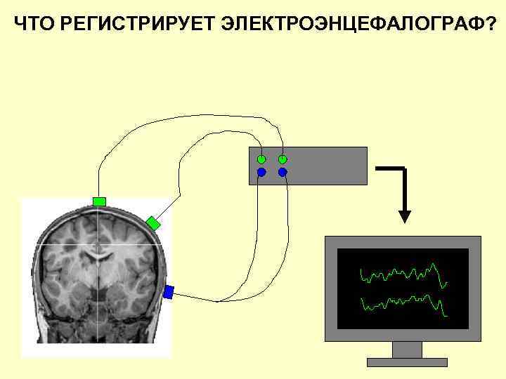 ЧТО РЕГИСТРИРУЕТ ЭЛЕКТРОЭНЦЕФАЛОГРАФ? 