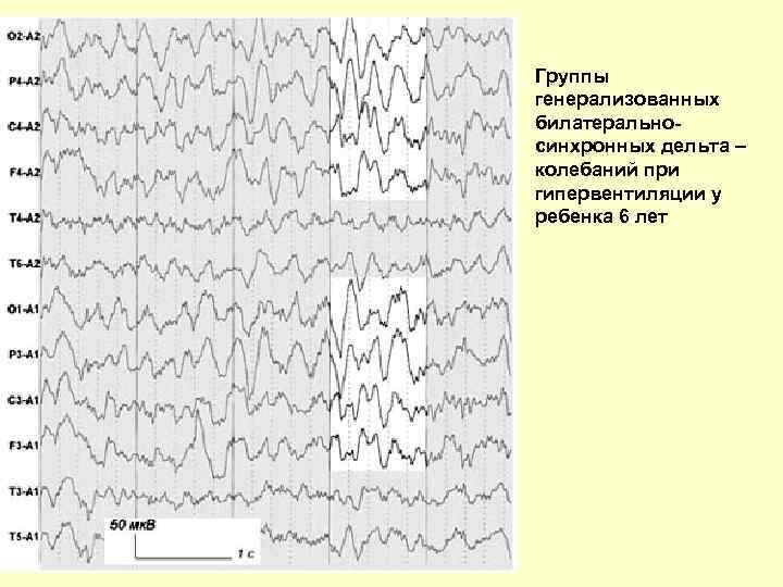 Синхронное колебание. Билатерально синхронных. Билатеральная синхронизация. Вторичные билатерально синхронные приступы. Колебания нейрогенные миорегенные.