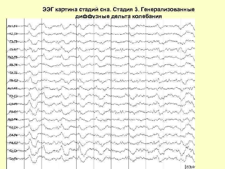 ЭЭГ картина стадий сна. Стадия 3. Генерализованные диффузные дельта колебания 