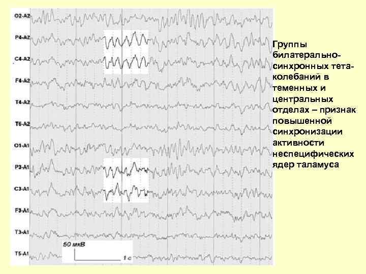 Группы билатеральносинхронных тетаколебаний в теменных и центральных отделах – признак повышенной синхронизации активности неспецифических