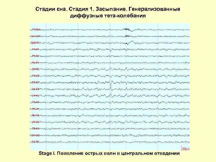 Стадии сна. Стадия 1. Засыпание. Генерализованные диффузные тета-колебания Stage I. Появление острых волн в