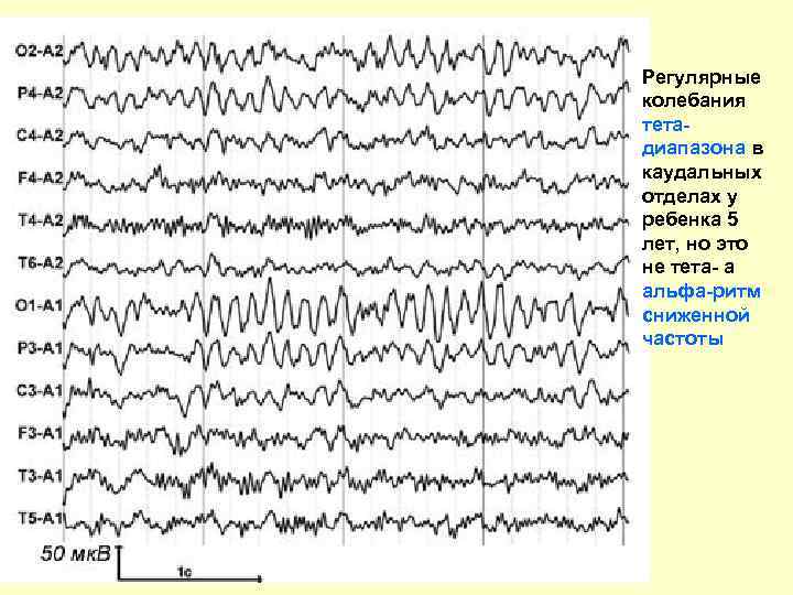 Регулярные колебания тетадиапазона в каудальных отделах у ребенка 5 лет, но это не тета-