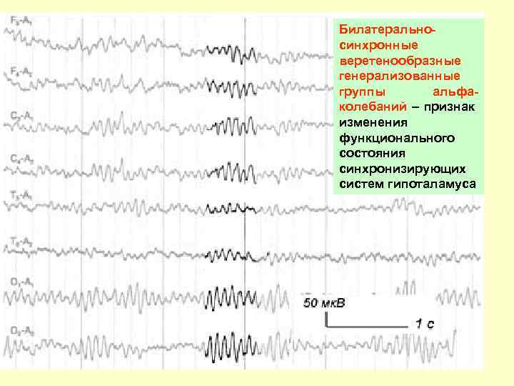 Билатеральносинхронные веретенообразные генерализованные группы альфаколебаний – признак изменения функционального состояния синхронизирующих систем гипоталамуса 