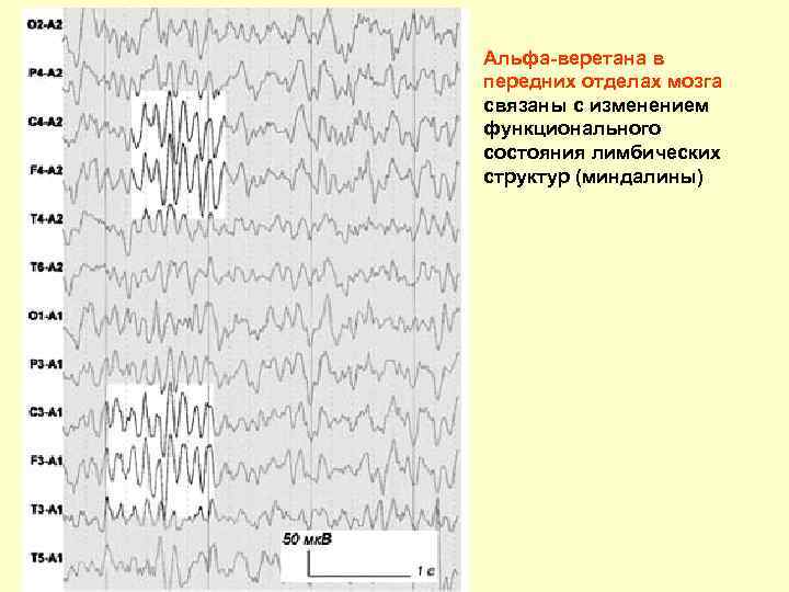 Альфа-веретана в передних отделах мозга связаны с изменением функционального состояния лимбических структур (миндалины) 
