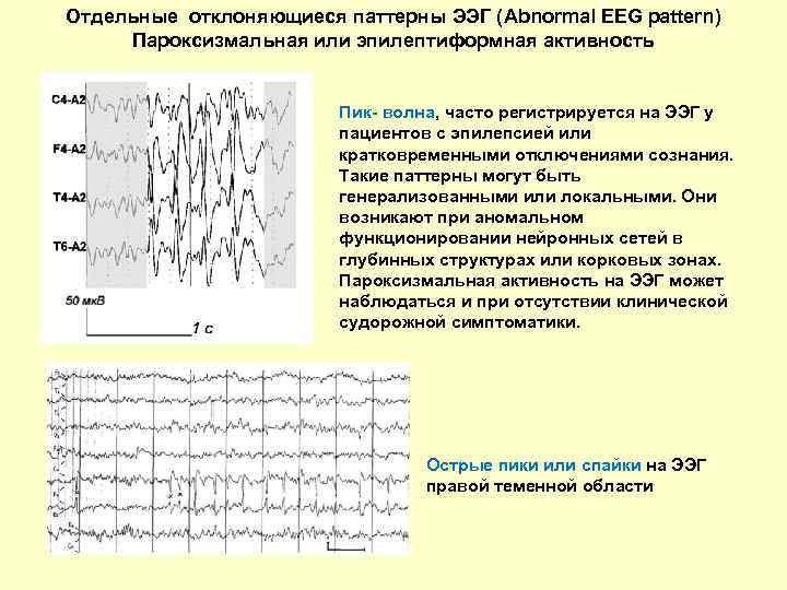 Признаки дезорганизации головного мозга. Эпилептиформные паттерны на ЭЭГ. Пароксизмальная активность на ЭЭГ У ребенка. Эпи паттерны на ЭЭГ. ЭЭГ эпилепсия пик-волна.