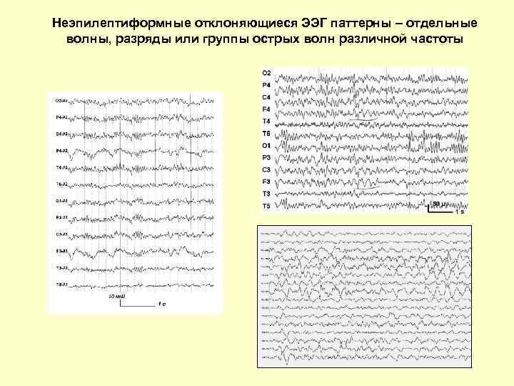 Неэпилептиформные отклоняющиеся ЭЭГ паттерны – отдельные волны, разряды или группы острых волн различной частоты