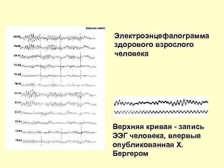 Электроэнцефалограмма здорового взрослого человека Верхняя кривая - запись ЭЭГ человека, впервые опубликованная Х. Бергером