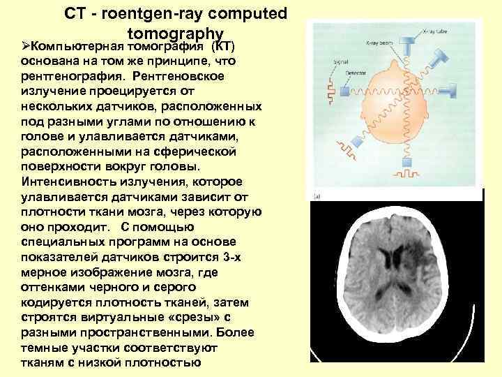 CT - roentgen-ray computed tomography ØКомпьютерная томография (КТ) основана на том же принципе, что