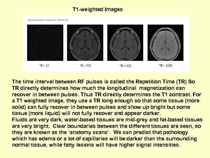 T 1 -weighted Images The time interval between RF pulses is called the Repetition