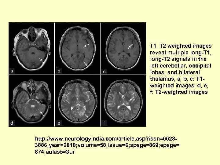 T 1, T 2 weighted images reveal multiple long-T 1, long-T 2 signals in