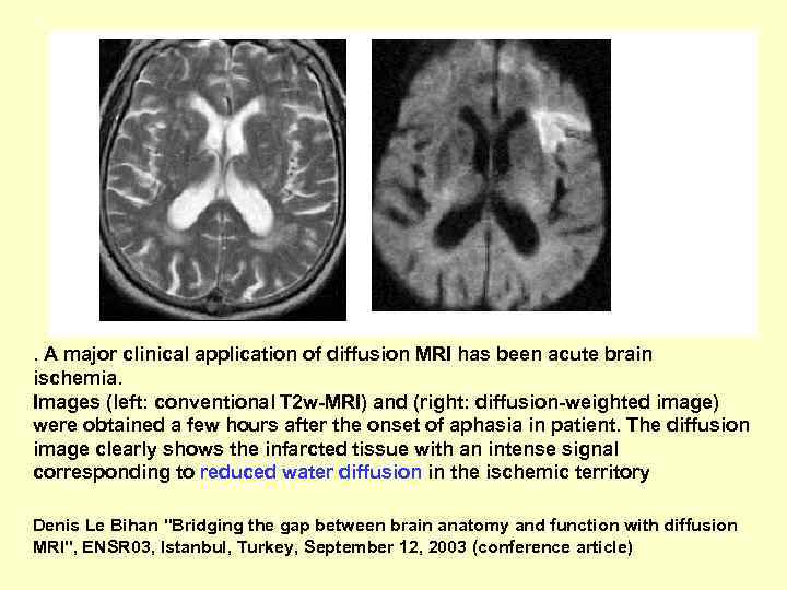 . A major clinical application of diffusion MRI has been acute brain ischemia. Images