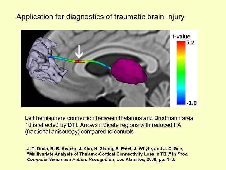 Application for diagnostics of traumatic brain Injury Left hemisphere connection between thalamus and Brodmann