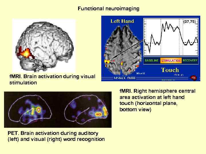 Functional neuroimaging f. MRI. Brain activation during visual stimulation f. MRI. Right hemisphere central