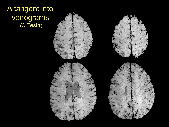 A tangent into venograms (3 Tesla) 