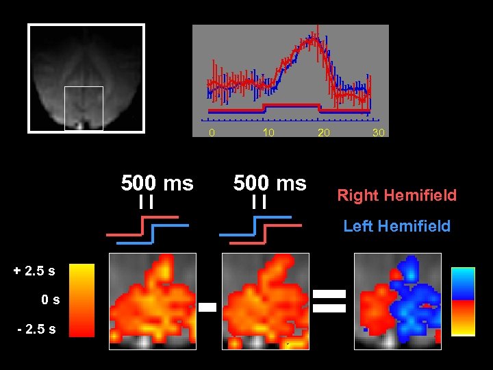 0 500 ms 10 500 ms 20 30 Right Hemifield Left Hemifield + 2.