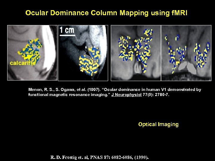 Ocular Dominance Column Mapping using f. MRI calcarine Menon, R. S. , S. Ogawa,