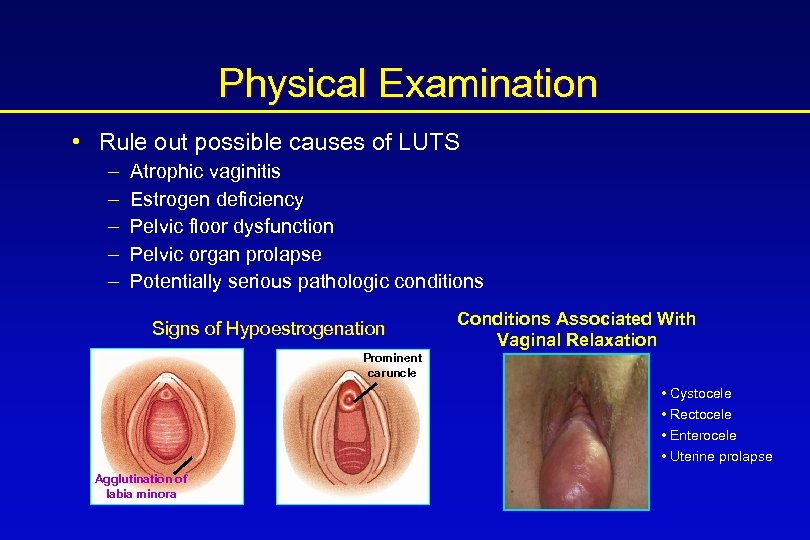 Physical Examination • Rule out possible causes of LUTS – – – Atrophic vaginitis