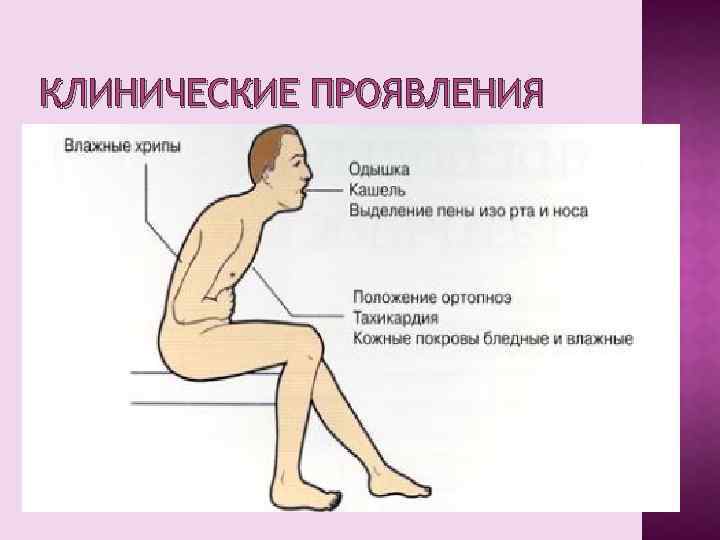КЛИНИЧЕСКИЕ ПРОЯВЛЕНИЯ 