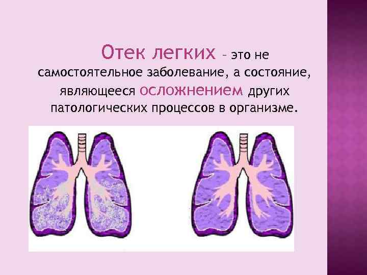 Отек легкого презентация