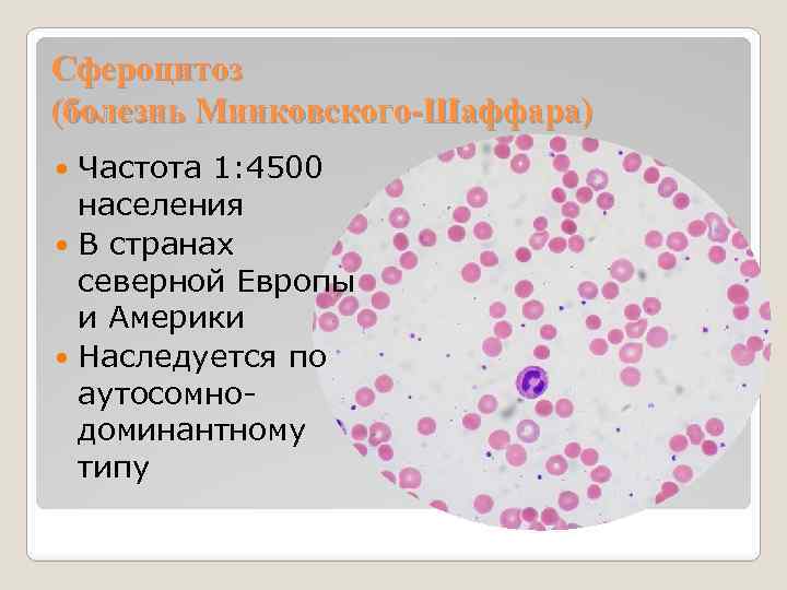 Сфероцитоз (болезнь Минковского-Шаффара) Частота 1: 4500 населения В странах северной Европы и Америки Наследуется