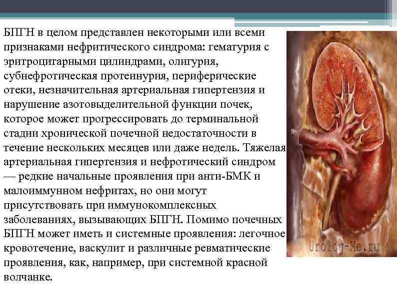 БПГН в целом представлен некоторыми или всеми признаками нефритического синдрома: гематурия с эритроцитарными цилиндрами,
