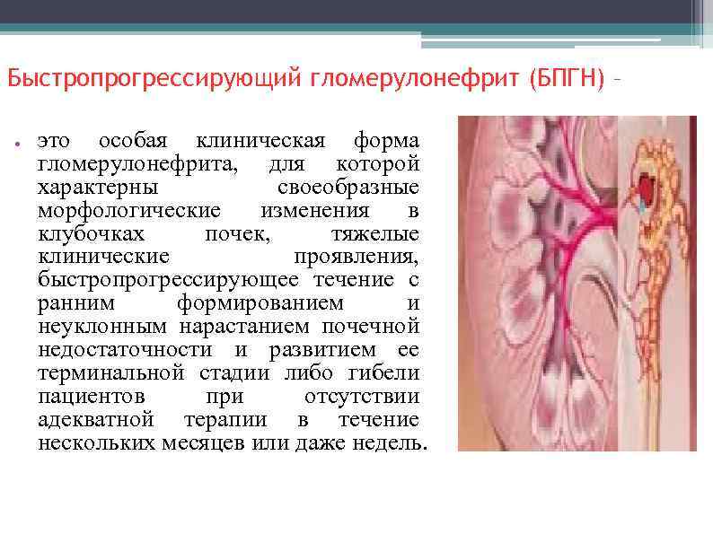 Быстропрогрессирующий гломерулонефрит (БПГН) – ● это особая клиническая форма гломерулонефрита, для которой характерны своеобразные