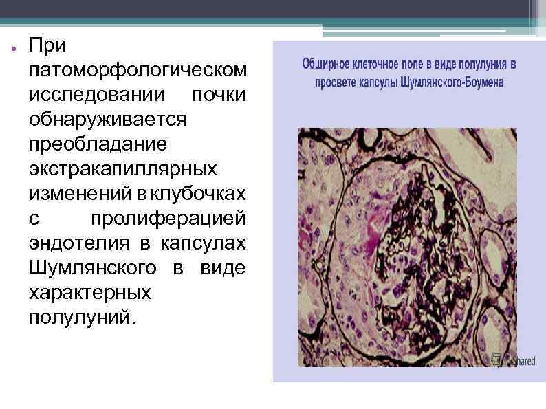 ● При патоморфологическом исследовании почки обнаруживается преобладание экстракапиллярных изменений в клубочках с пролиферацией эндотелия