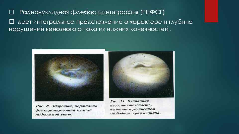  Радионуклидная флебостцинтиграфия (РНФСГ) дает интегральное представление о характере и глубине нарушений венозного оттока