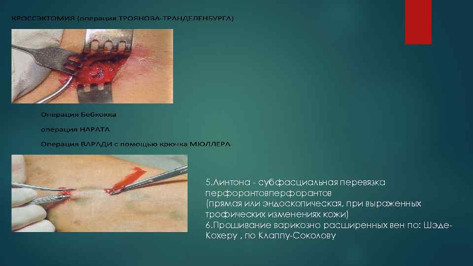 5. Линтона - субфасциальная перевязка перфорантов (прямая или эндоскопическая, при выраженных трофических изменениях кожи)