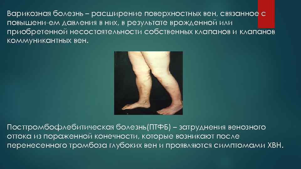 Варикозная болезнь – расширение поверхностных вен, связанное с повышени-ем давления в них, в результате