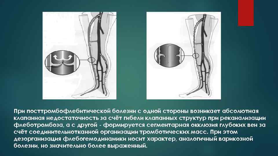 Недостаточность клапанов нижних конечностей