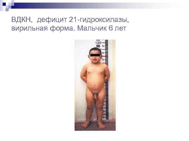 ВДКН, дефицит 21 -гидроксилазы, вирильная форма. Мальчик 6 лет 