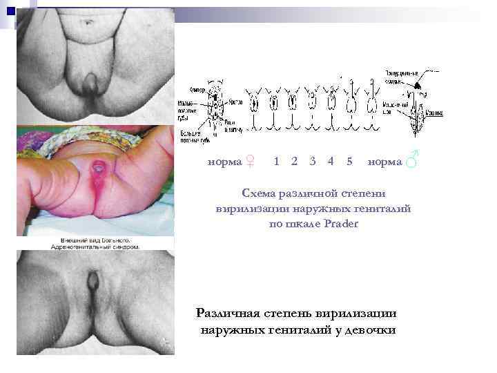 норма ♀ 1 2 3 4 5 норма ♂ Схема различной степени вирилизации наружных