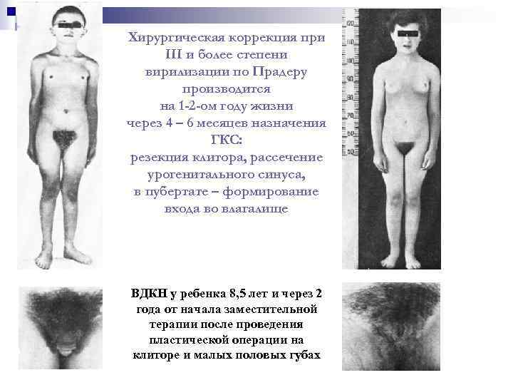 Хирургическая коррекция при III и более степени вирилизации по Прадеру производится на 1 -2