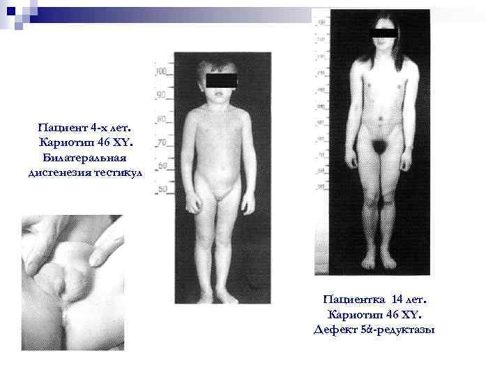 Пациент 4 -х лет. Кариотип 46 XY. Билатеральная дисгенезия тестикул Пациентка 14 лет. Кариотип