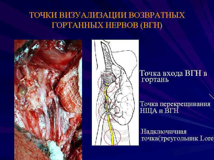 ТОЧКИ ВИЗУАЛИЗАЦИИ ВОЗВРАТНЫХ ГОРТАННЫХ НЕРВОВ (ВГН) Точка входа ВГН в гортань Точка перекрещивания НЩА