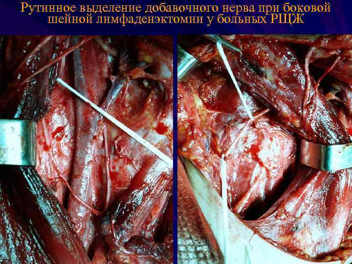 Рутинное выделение добавочного нерва при боковой шейной лимфаденэктомии у больных РЩЖ 