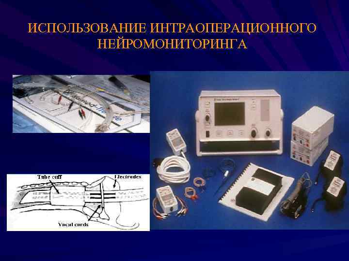 ИСПОЛЬЗОВАНИЕ ИНТРАОПЕРАЦИОННОГО НЕЙРОМОНИТОРИНГА 