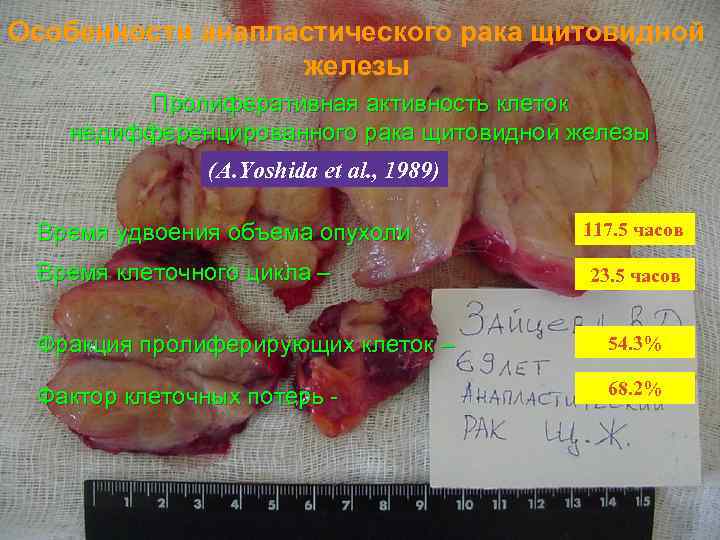 Особенности анапластического рака щитовидной железы Пролиферативная активность клеток недифференцированного рака щитовидной железы (A. Yoshida