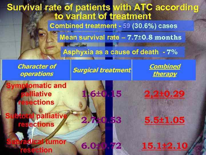 Survival rate of patients with ATC according to variant of treatment Combined treatment -