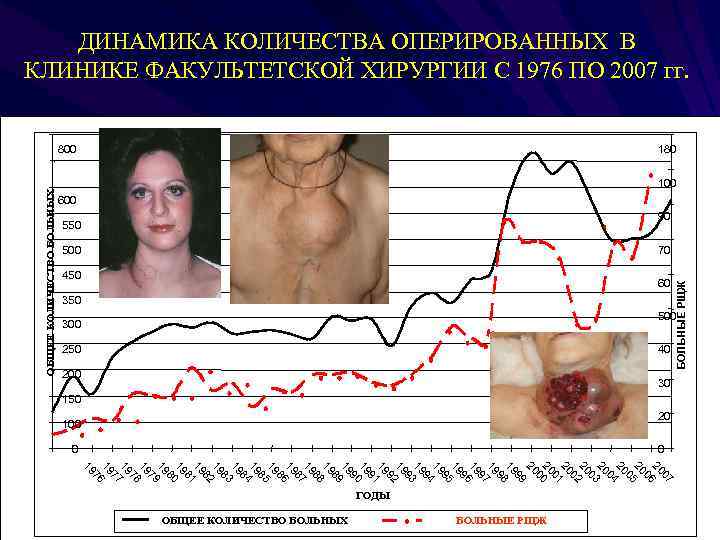 ДИНАМИКА КОЛИЧЕСТВА ОПЕРИРОВАННЫХ В КЛИНИКЕ ФАКУЛЬТЕТСКОЙ ХИРУРГИИ С 1976 ПО 2007 гг. 800 180