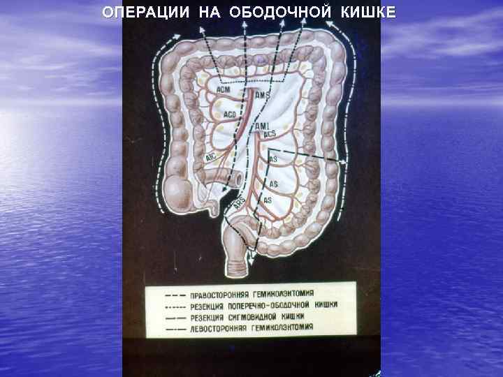 ОПЕРАЦИИ НА ОБОДОЧНОЙ КИШКЕ 