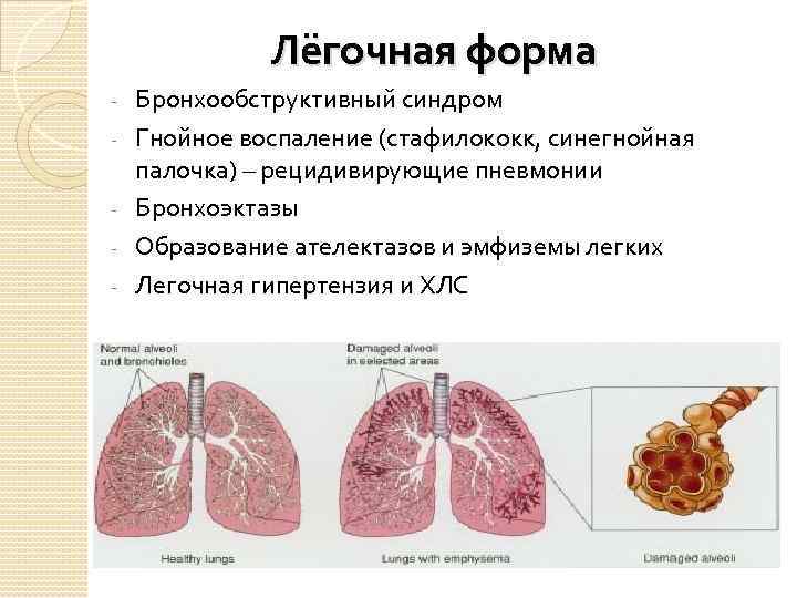 Лёгочная форма Бронхообструктивный синдром Гнойное воспаление (стафилококк, синегнойная палочка) – рецидивирующие пневмонии Бронхоэктазы Образование