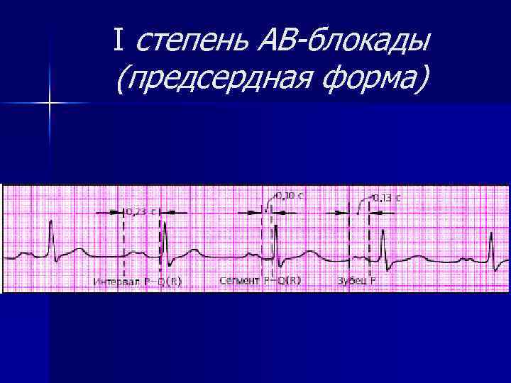 I степень АВ-блокады (предсердная форма) 