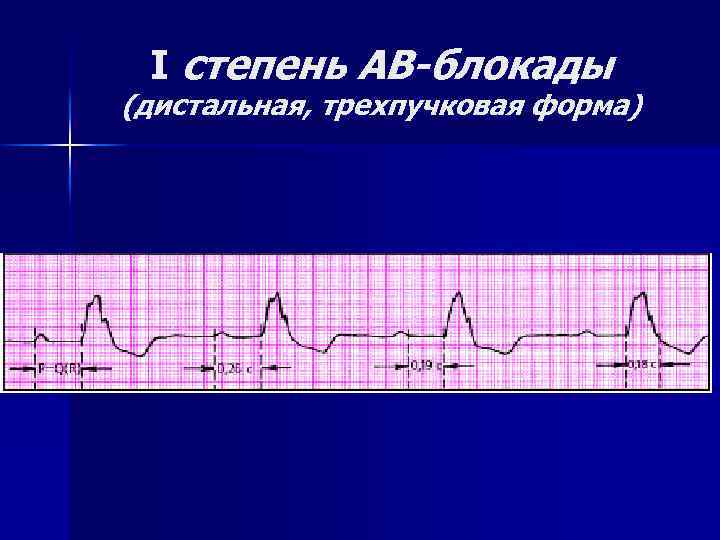 I степень АВ-блокады (дистальная, трехпучковая форма) 