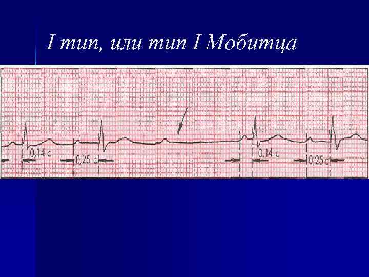 I тип, или тип I Мобитца 