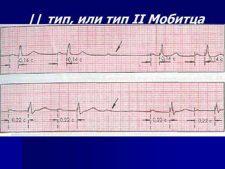 // тип, или тип II Мобитца 
