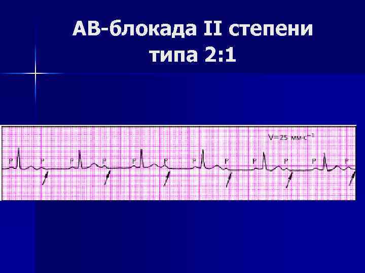 АВ-блокада II степени типа 2: 1 