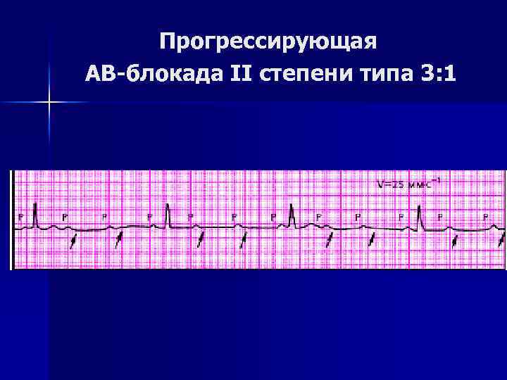 Прогрессирующая АВ-блокада II степени типа 3: 1 