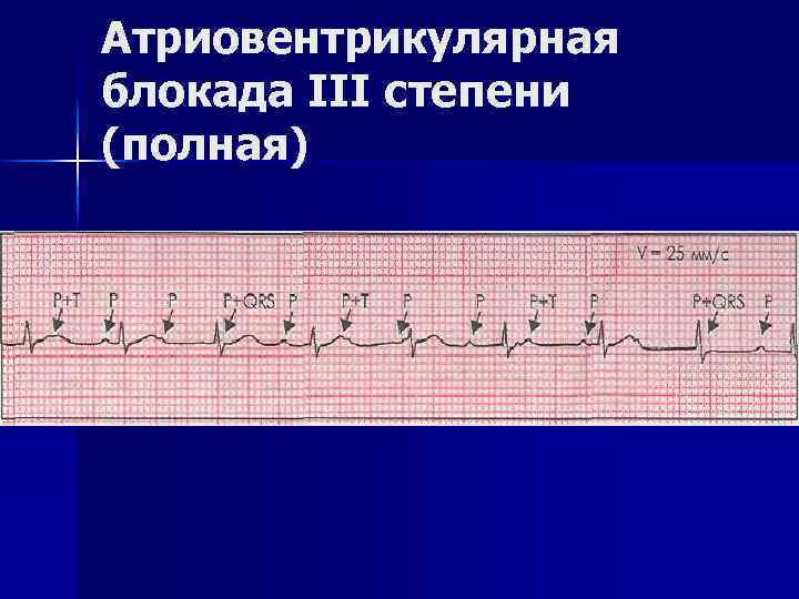 Атриовентрикулярная блокада III степени (полная) 